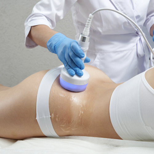 radio frequency treatment illustration
